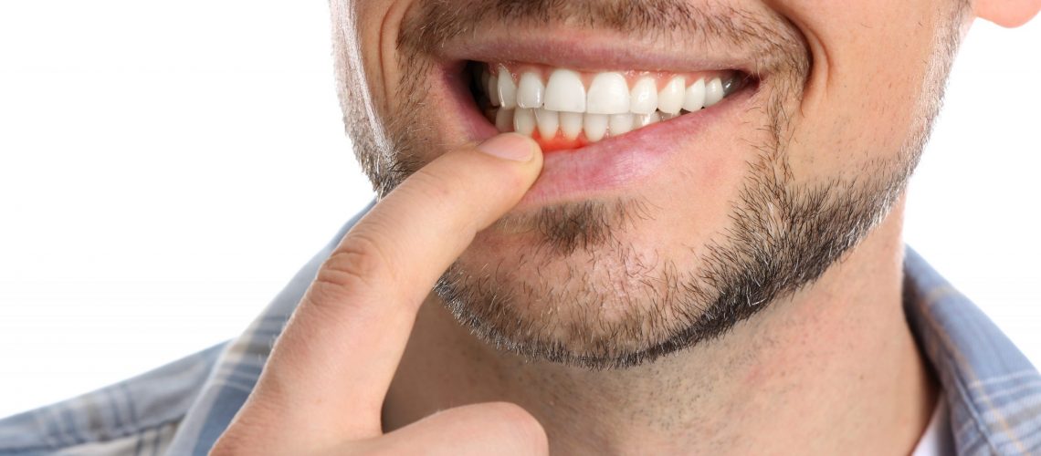 Scaling of Teeth
